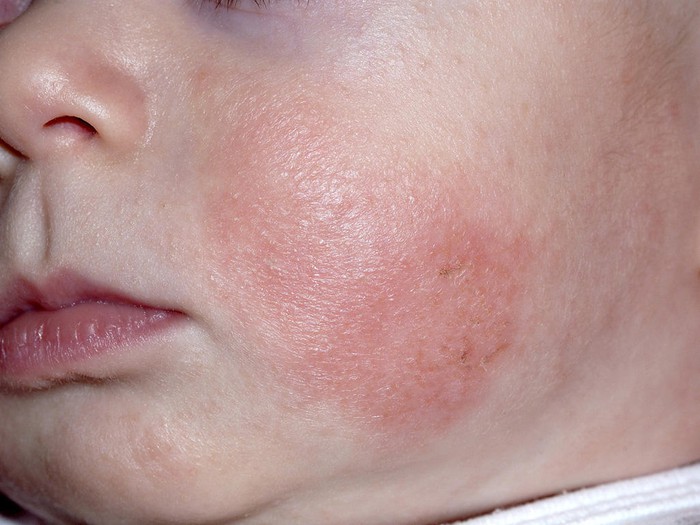 Những vấn đề về da ở trẻ thường gặp vào mùa đông - Ảnh 1.