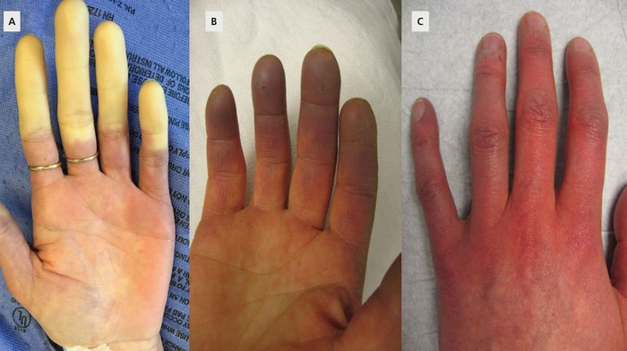 Tìm hiểu về hội chứng Raynaud khiến tay bị tím tái, đau buốt vào mùa đông - Ảnh 1.