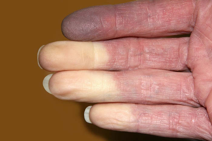 Tìm hiểu về hội chứng Raynaud khiến tay bị tím tái, đau buốt vào mùa đông - Ảnh 2.