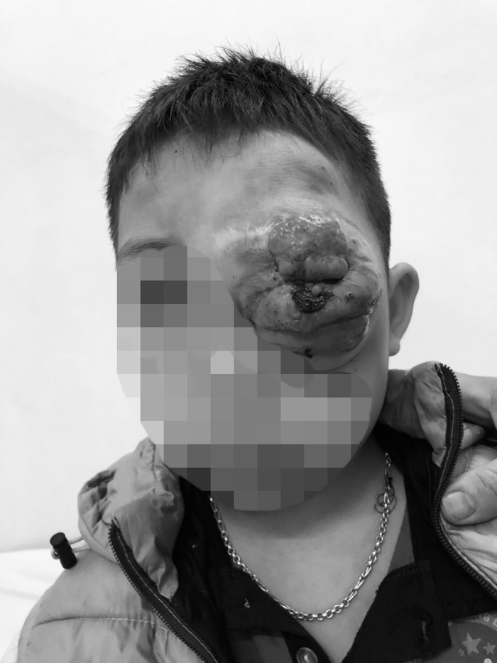 Bé trai bị lồi mắt, gương mặt biến dạng vì không có tiền chữa trị bệnh - Ảnh 1.