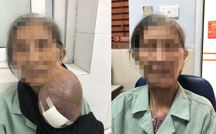 Cụ bà 40 năm đeo khối u khổng lồ trên cổ
