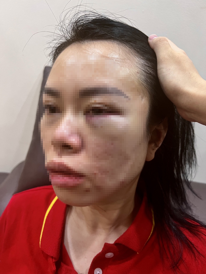 Người phụ nữ tố bị chồng cũ &quot;bắt cóc&quot; tra tấn dã man: Nhốt trong ô tô, đánh từ Hà Nội lên Hòa Bình - Ảnh 1.