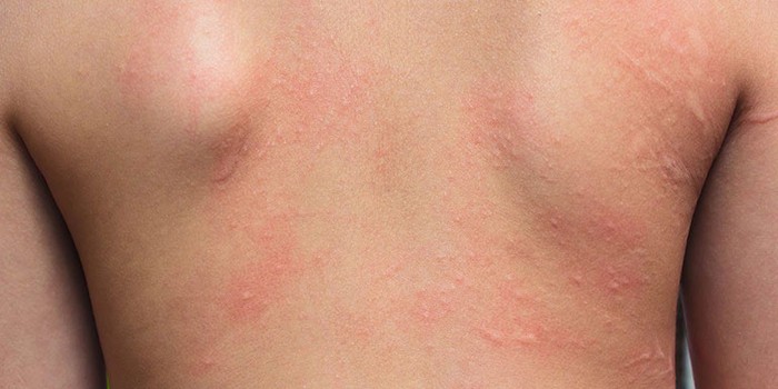 Làm thế nào để đối phó với các bệnh về da vào mùa mưa - Ảnh 2.