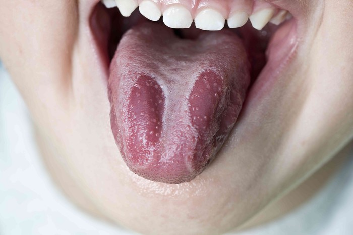 Vàng lưỡi là dấu hiệu cảnh báo những bệnh lý gì? - Ảnh 4.