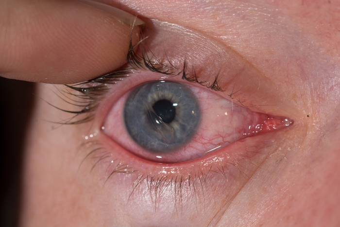 10 nguyên nhân gây đỏ mắt và cách điều trị - Ảnh 3.