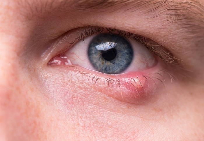 10 nguyên nhân gây đỏ mắt và cách điều trị - Ảnh 6.