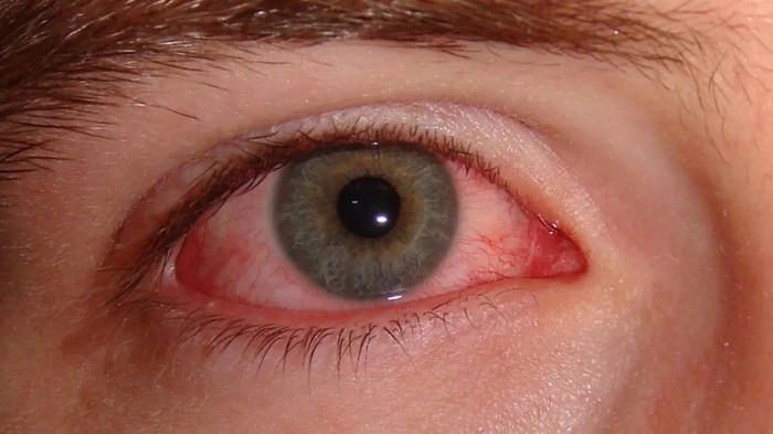 10 nguyên nhân gây đỏ mắt và cách điều trị - Ảnh 1.