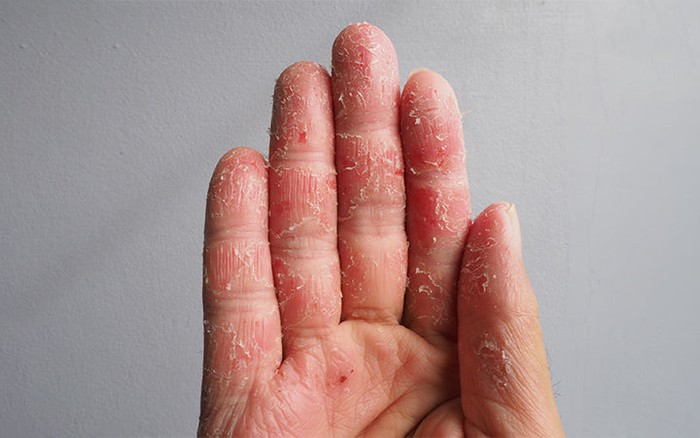 Bong tróc da đầu ngón tay: Nguyên nhân, cách điều trị và phòng ngừa- Ảnh 2.