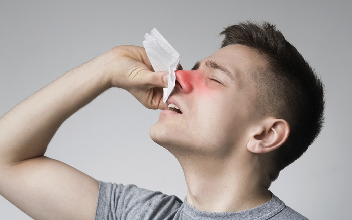 Viêm mũi dị ứng theo mùa Viêm mũi dị ứng theo mùa