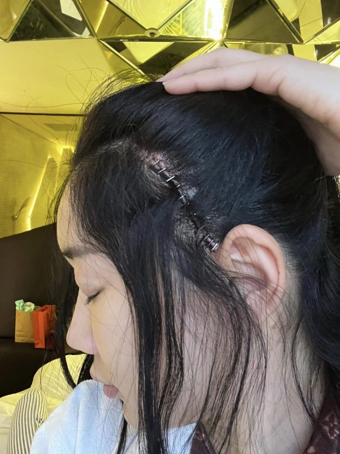 Hoa hậu thị phi nhất Thái Lan gây sốc khi tiết lộ vết sẹo đáng sợ sau phẫu thuật thẩm mỹ - Ảnh 2.