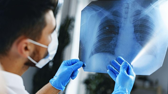 3 triệu chứng nghiêm trọng cảnh báo ung thư phổi: Người trên 40 tuổi càng phải đề phòng - Ảnh 3.