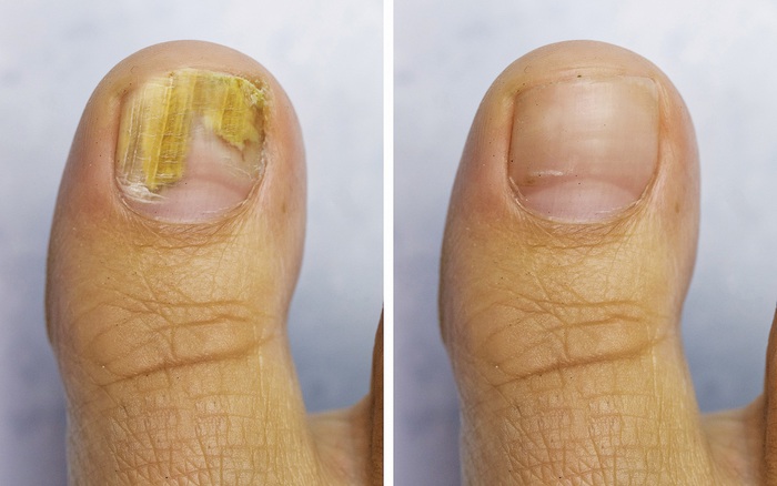 Các biện pháp phòng ngừa nấm móng vào mùa hè