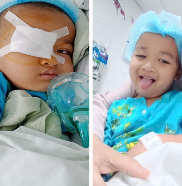 Bị kéo đập vào mắt, bé 4 tuổi bị rách giác mạc, vỡ thuỷ tinh thể  - Ảnh 1.