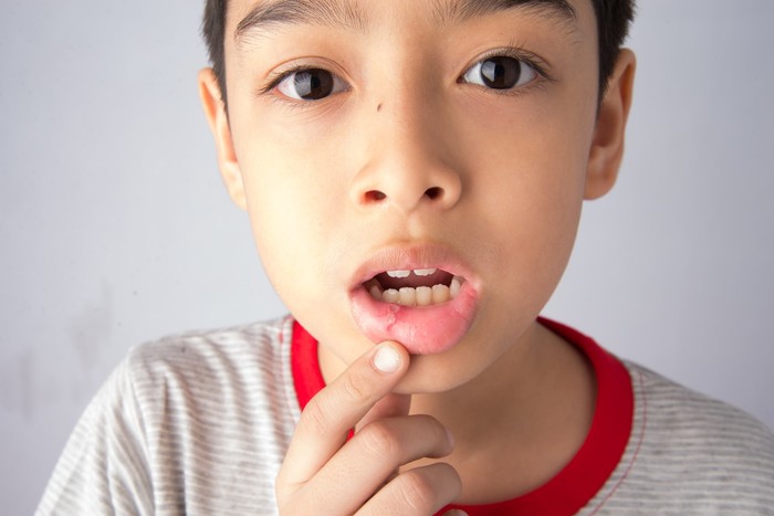 Chuyên gia chia sẻ cách chăm sóc cho trẻ khi bị nhiệt miệng - Ảnh 2.