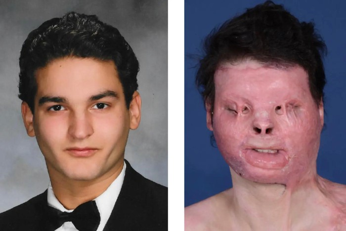 Người đầu tiên được phẫu thuật ghép mặt trên thế giới sau 3 năm: Cuộc sống thay đổi thần kỳ, tìm được tình yêu bên bạn gái xinh đẹp - Ảnh 1.