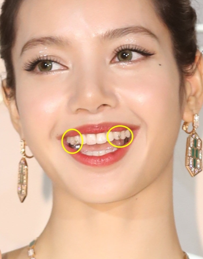 Xu hướng ‘răng đính ngọc’ được Lisa và loạt idol sử dụng gây tranh cãi - Ảnh 2.