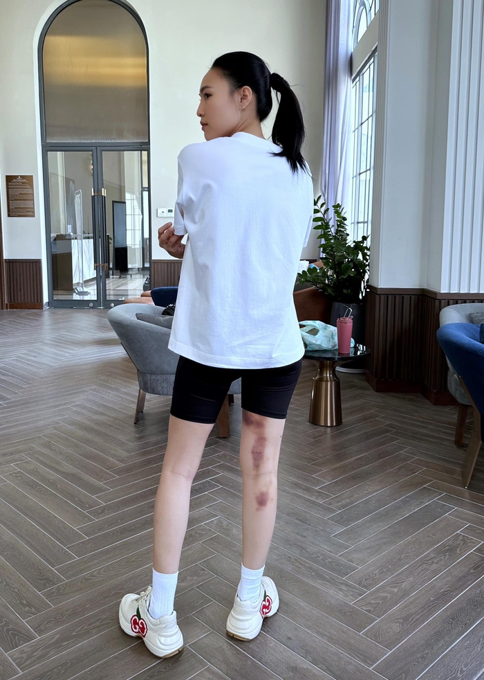 Ninh Dương Lan Ngọc khiến khán giả lo lắng khi lộ vết bầm tím lớn ở chân - Ảnh 2.