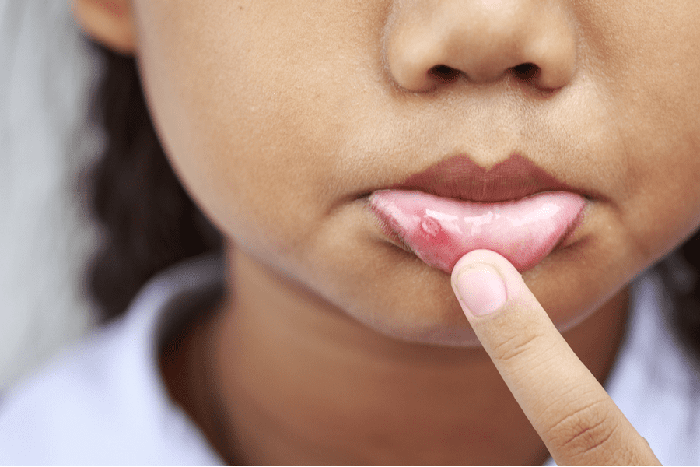 Cách phân biệt nấm miệng và nhiệt miệng ở trẻ - Ảnh 3.
