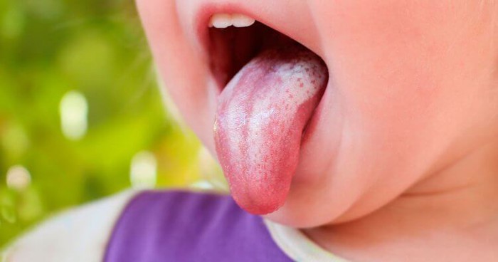 Cách phân biệt nấm miệng và nhiệt miệng ở trẻ - Ảnh 2.