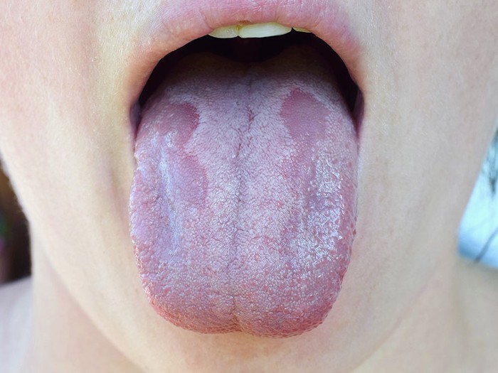 Cách phân biệt nấm miệng và nhiệt miệng ở trẻ - Ảnh 1.