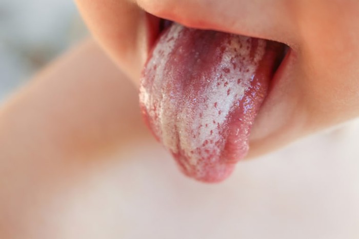 Cách phân biệt nấm miệng và nhiệt miệng ở trẻ - Ảnh 6.
