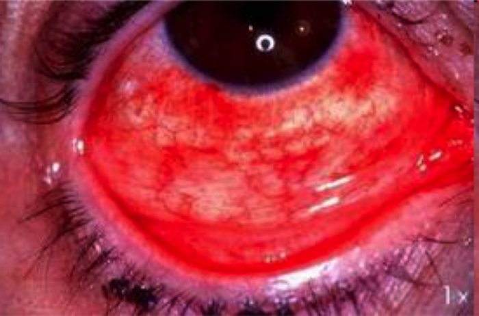 Bệnh đau mắt đỏ đang diễn biến khó lường - Ảnh 1.