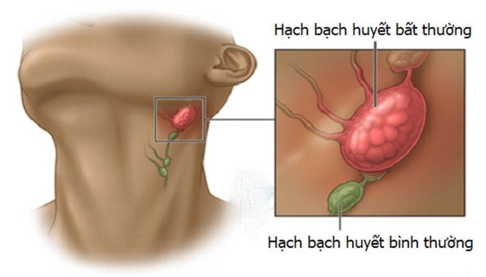 Nổi hạch khám không ra bệnh, xét nghiệm tại MEDLATEC phát hiện mắc ung thư- Ảnh 4.