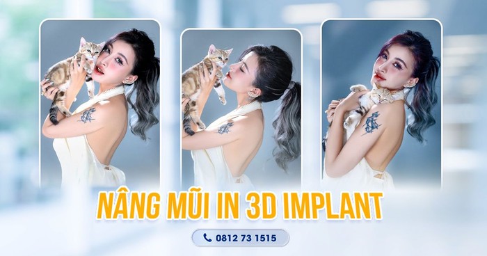 Bác sĩ Nguyễn Tuấn Anh cùng ứng dụng công nghệ Nâng Mũi In 3D Implant- Ảnh 2.