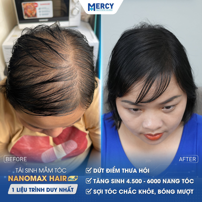Phòng khám Mercy nổi tiếng trong ứng dụng CNC vào điều tri rụng tóc, hói đầu- Ảnh 4.