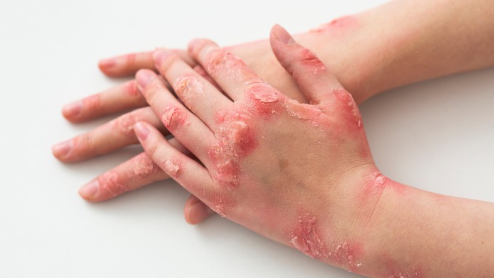10 tình trạng ở bàn tay có thể là triệu chứng của bệnh tiềm ẩn- Ảnh 4.