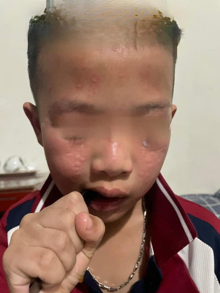 Hà Nội: Nhiều học sinh bị ngứa, nôn mửa sau khi trường phun thuốc muỗi- Ảnh 1.
