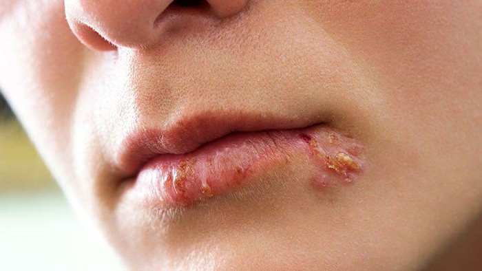 Bạn có thể bị mụn rộp do nhiễm virus Herpes khi đi bơi không?- Ảnh 1.