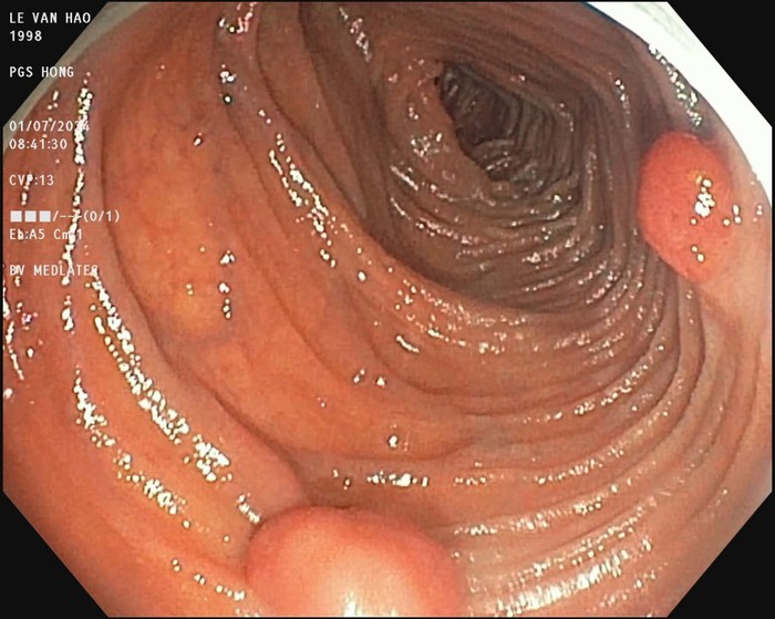 Cảnh báo bệnh đa polyp di truyền trong gia đình - bệnh hiếm gặp điều trị thành công tại MEDLATEC  - Ảnh 1.