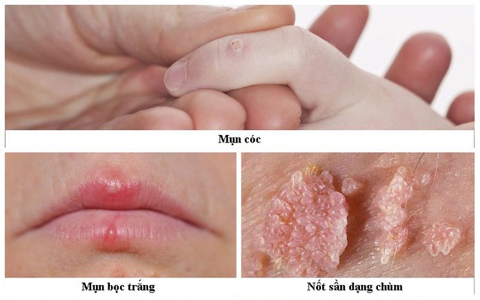 Người đàn ông bất ngờ phát hiện mắc ung thư ở miệng vì chủng virus anh nghĩ chỉ gây bệnh cho phụ nữ- Ảnh 5.