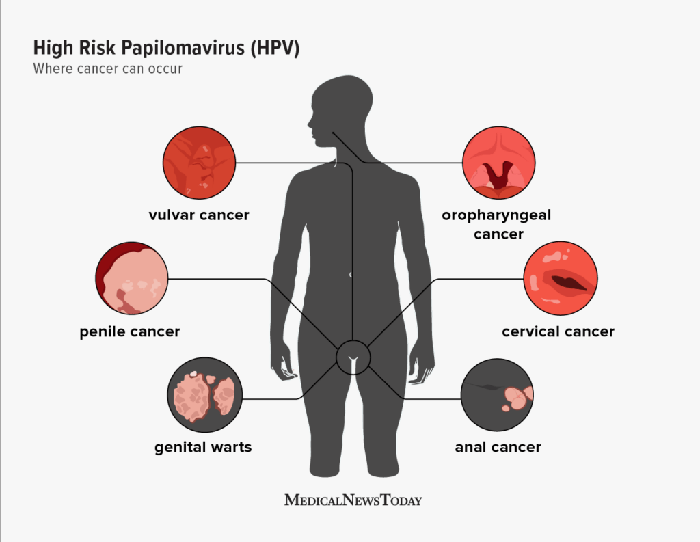 Người đàn ông bất ngờ phát hiện mắc ung thư ở miệng vì chủng virus anh nghĩ chỉ gây bệnh cho phụ nữ- Ảnh 7.