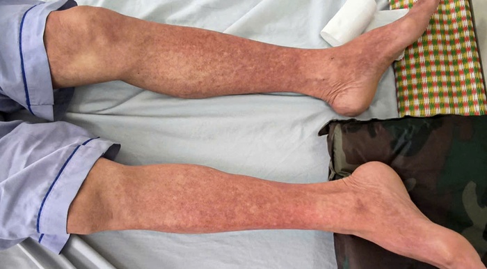 Sốt xuất huyết Dengue nặng gia tăng, nhiều ca sốc nguy kịch- Ảnh 1. Sốt xuất huyết Dengue nặng gia tăng, nhiều ca sốc nguy kịch- Ảnh 1.