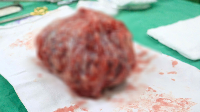 Giành giật sự sống cho sản phụ có khối u xơ kích thước lớn hơn 1kg - Ảnh 2. Giành giật sự sống cho sản phụ có khối u xơ kích thước lớn hơn 1kg - Ảnh 2.