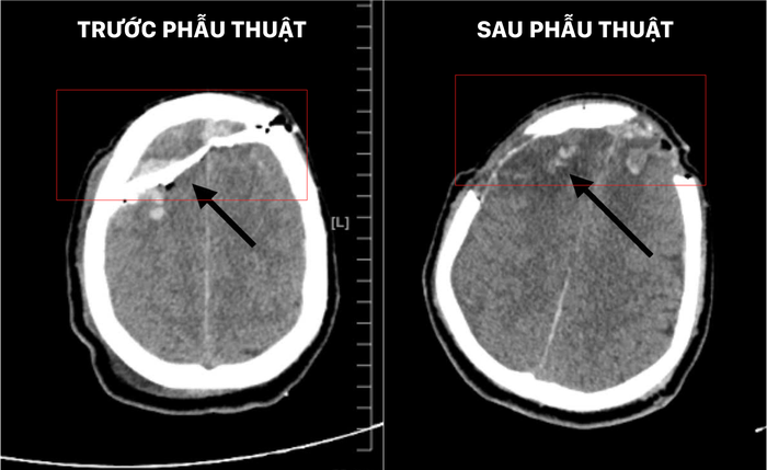 Phẫu thuật cứu sống bệnh nhân nước ngoài bị vỡ sọ, dập não- Ảnh 1.