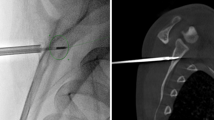 Thoát khỏi 5 năm đau đớn nhờ "đốt sóng cao tần" triệt tiêu khối u - Ảnh 2. Thoát khỏi 5 năm đau đớn nhờ "đốt sóng cao tần" triệt tiêu khối u - Ảnh 2.