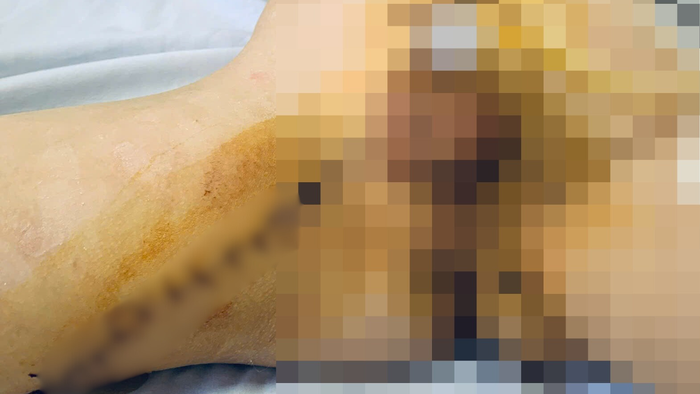Nối lại vùng kín bị đứt lìa cho bệnh nhi 9 tuổi - Ảnh 1.