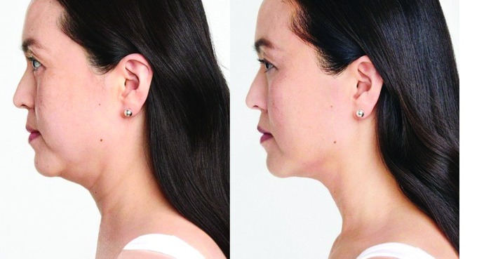 Sự thật về công nghệ nâng mặt, xóa nọng cằm 
bằng sóng siêu âm- Ảnh 2.