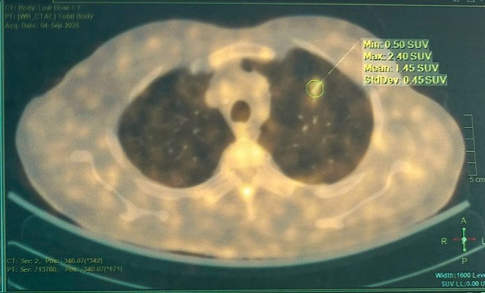 Phát hiện ung thư phổi giai đoạn sớm nhờ tổn thương “kính mờ” được AI cảnh báo- Ảnh 1. Phát hiện ung thư phổi giai đoạn sớm nhờ tổn thương “kính mờ” được AI cảnh báo- Ảnh 1.