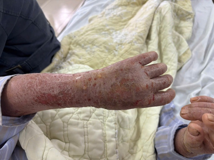 Bôi thuốc lá để chữa ngứa, cụ bà nhập viện với tình trạng da bong vảy khắp người- Ảnh 1. Bôi thuốc lá để chữa ngứa, cụ bà nhập viện với tình trạng da bong vảy khắp người- Ảnh 1.