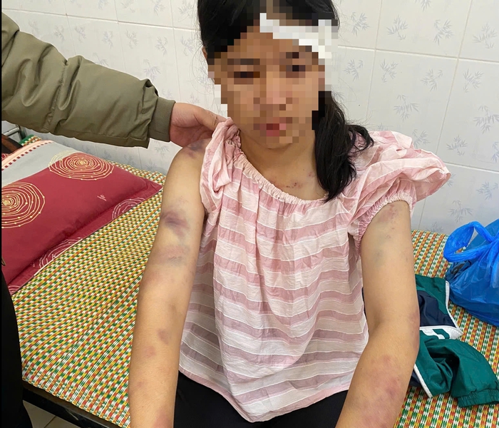 Bác sĩ thông tin về sức khỏe bé gái 13 tuổi nghi bị bạo hành ở Thái Nguyên- Ảnh 1. Bác sĩ thông tin về sức khỏe bé gái 13 tuổi nghi bị bạo hành ở Thái Nguyên- Ảnh 1.