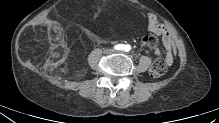 Cụ bà 76 tuổi bụng to bất thường, đi khám phát hiện u hiếm gặp - Ảnh 1.