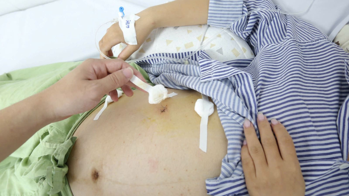 Giành lại sự sống cho sản phụ 32 tuần bị viêm ruột thừa nguy kịch- Ảnh 1. Giành lại sự sống cho sản phụ 32 tuần bị viêm ruột thừa nguy kịch- Ảnh 1.