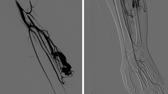 Đau tê ngón tay, cô gái trẻ phát hiện mắc bệnh gây ra tình trạng "ăn cắp máu" - Ảnh 1. Đau tê ngón tay, cô gái trẻ phát hiện mắc bệnh gây ra tình trạng "ăn cắp máu" - Ảnh 1.