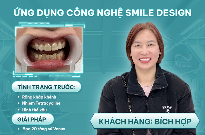 Thiết kế nụ cười độc bản bằng công nghệ Smile Design tại Nha khoa Thiên Hà- Ảnh 1.