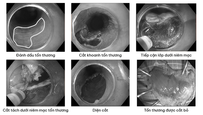 Đi khám sức khỏe phát hiện tổn thương tiền ung thư, bệnh nhân được điều trị triệt căn bằng kỹ thuật hiện đại nhất thế giới      - Ảnh 1.