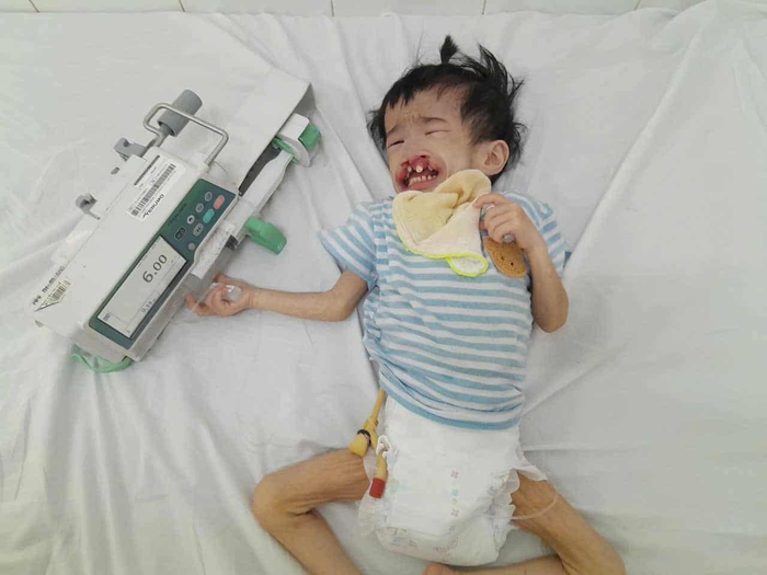 Bé gái 3 tuổi có khuôn mặt biến dạng vì dị tật mong chờ cơ hội được phẫu thuật- Ảnh 4. Bé gái 3 tuổi có khuôn mặt biến dạng vì dị tật mong chờ cơ hội được phẫu thuật- Ảnh 4.